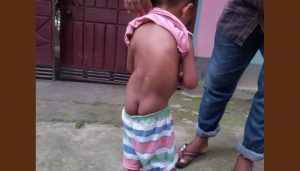 In Ranishankoil, child Meem's spinal cord is broken and needs 5 lakh rupees for treatment